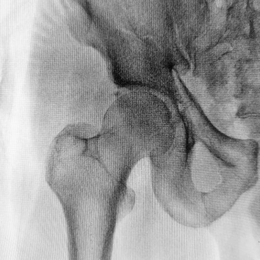 How Often Do You Think About Your Bone Health